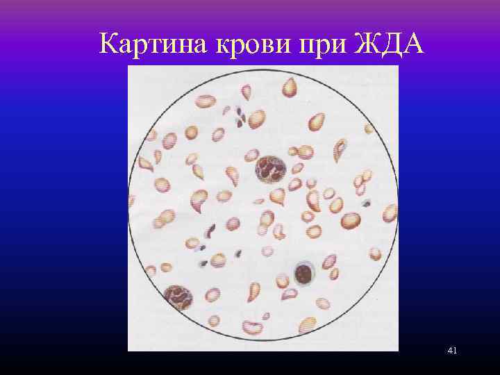 Картина крови при ЖДА 41 