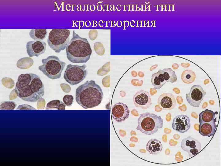 Мегалобластный тип кроветворения 60 