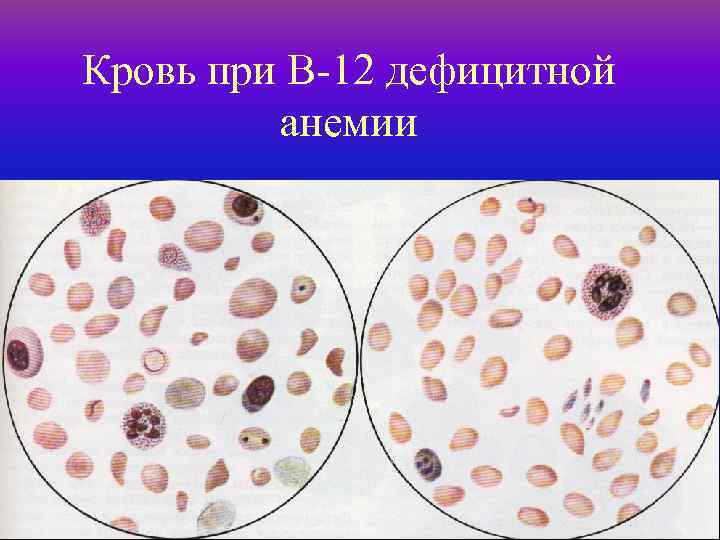 Кровь при В-12 дефицитной анемии 61 
