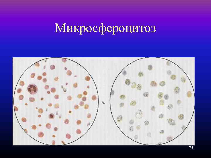 Микросфероцитоз 75 