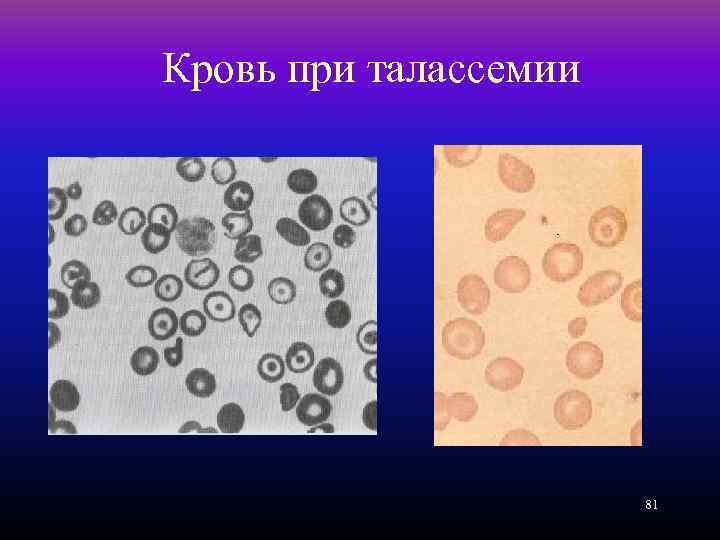 Кровь при талассемии 81 