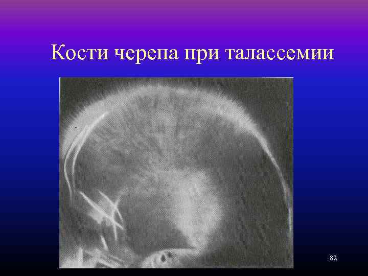 Кости черепа при талассемии 82 