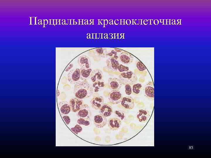 Парциальная красноклеточная аплазия 85 