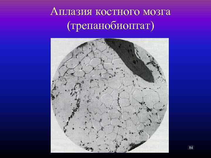 Аплазия костного мозга (трепанобиоптат) 86 
