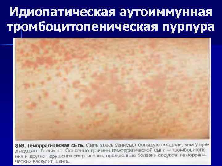 Идиопатическая аутоиммунная тромбоцитопеническая пурпура 
