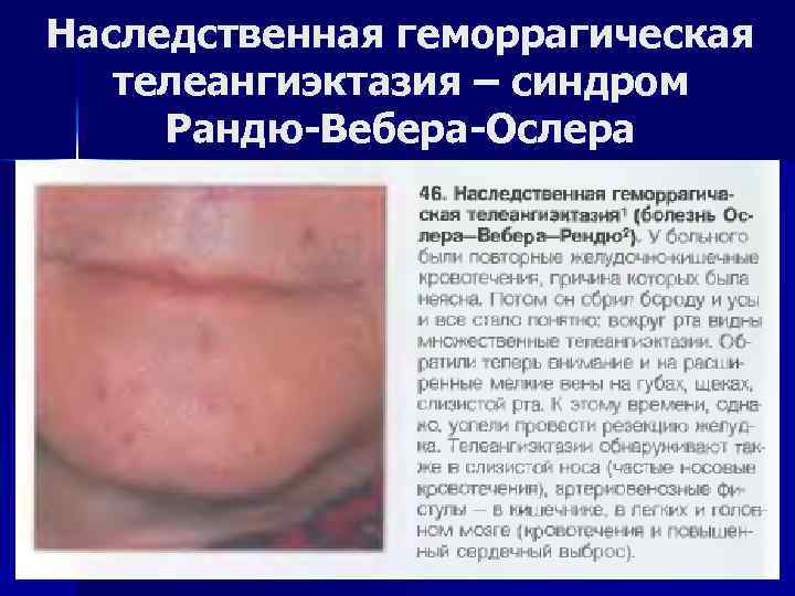 Наследственная геморрагическая телеангиэктазия – синдром Рандю-Вебера-Ослера 