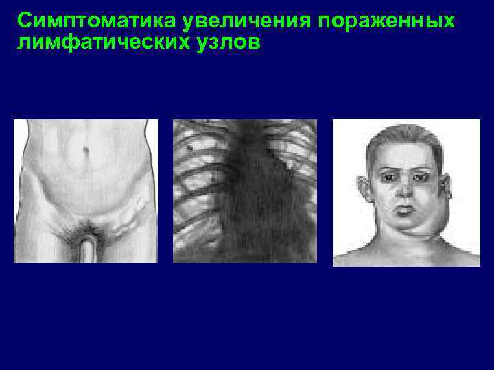 Симптоматика увеличения пораженных лимфатических узлов 