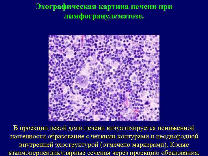 Эхографическая картина печени при лимфогранулематозе. В проекции левой доли печени визуализируется пониженной эхогенности образование