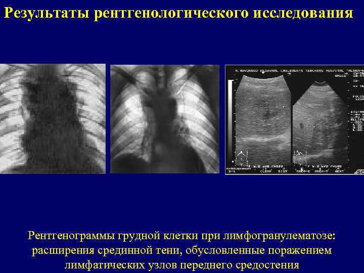 Результаты рентгенологического исследования Рентгенограммы грудной клетки при лимфогранулематозе: расширения срединной тени, обусловленные поражением лимфатических