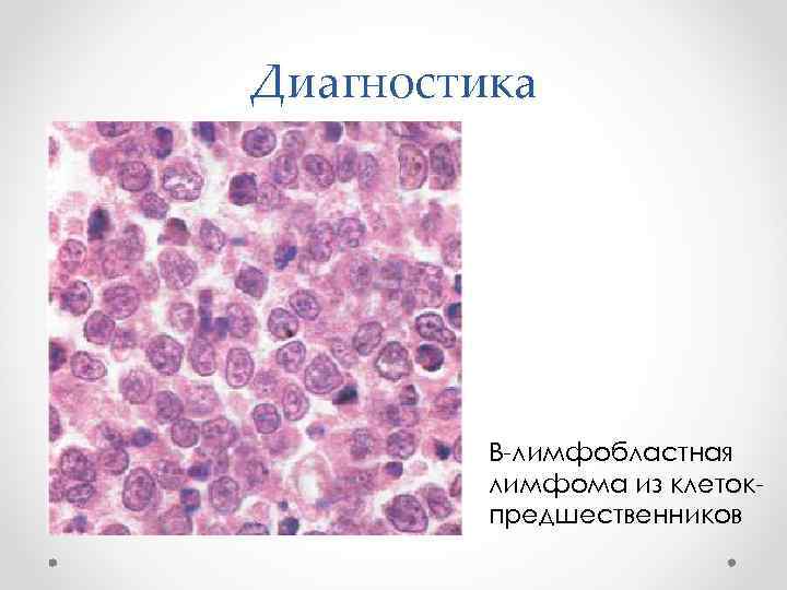 Диагностика В-лимфобластная лимфома из клетокпредшественников 