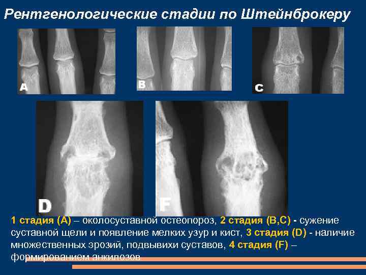 Рентгенологические стадии по Штейнброкеру 1 стадия (А) – околосуставной остеопороз, 2 стадия (В, С)