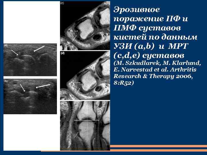 Эрозивное поражение ПФ и ПМФ суставов кистей по данным УЗИ (a, b) и МРТ