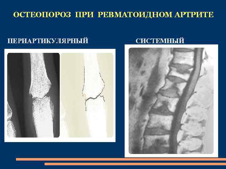 ОСТЕОПОРОЗ ПРИ РЕВМАТОИДНОМ АРТРИТЕ ПЕРИАРТИКУЛЯРНЫЙ СИСТЕМНЫЙ 