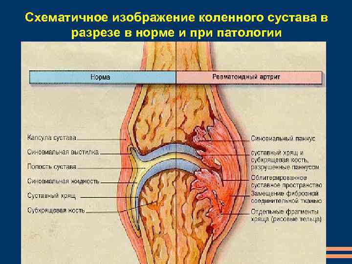 Схематичное изображение коленного сустава в разрезе в норме и при патологии 