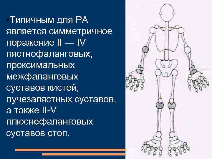  • Типичным для РА является симметричное поражение II — IV пястнофаланговых, проксимальных межфаланговых