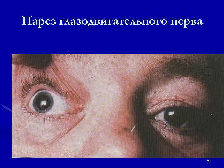 Парез глазодвигательного нерва 25 
