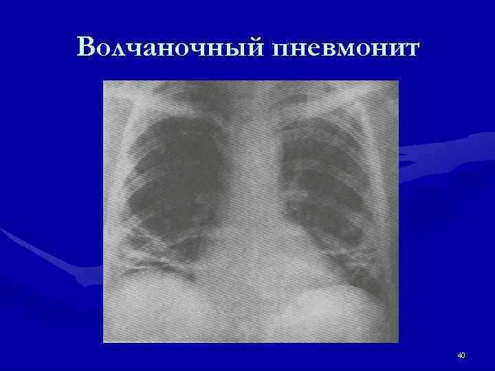 Волчаночный пневмонит 40 