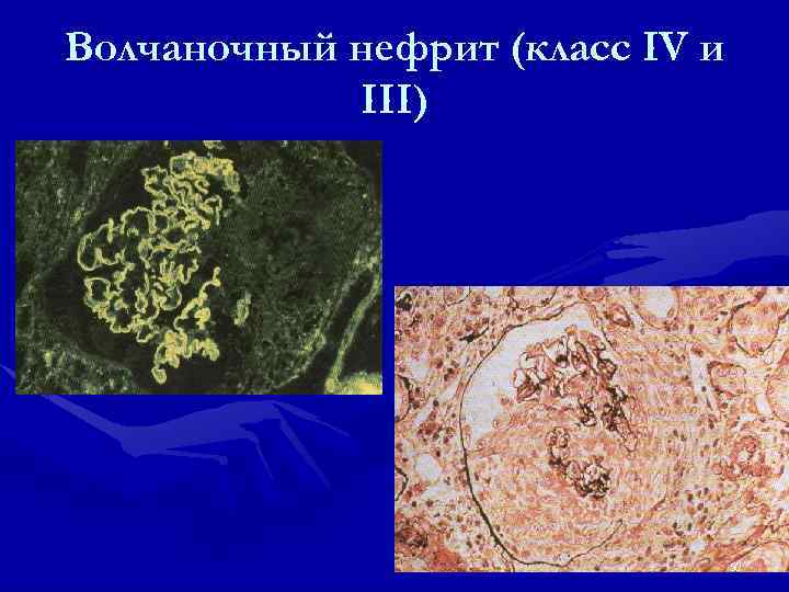 Волчаночный нефрит (класс IV и III) 50 