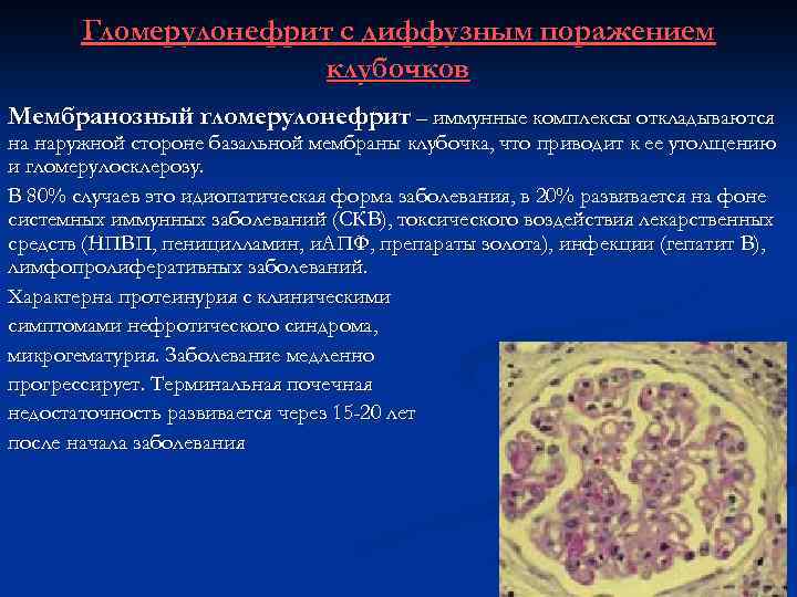 Гломерулонефрит с диффузным поражением клубочков Мембранозный гломерулонефрит – иммунные комплексы откладываются на наружной стороне