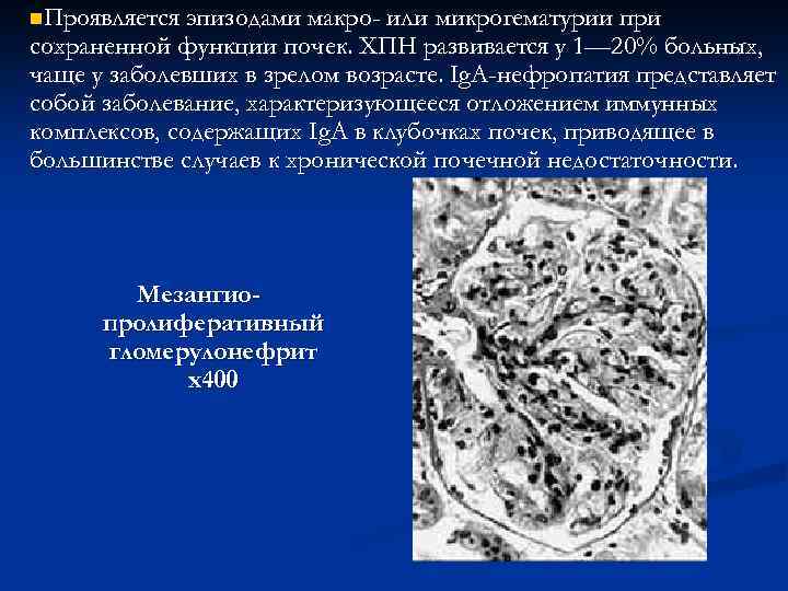 n. Проявляется эпизодами макро- или микрогематурии при сохраненной функции почек. ХПН развивается у 1—