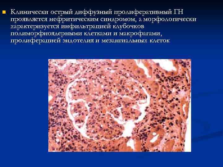 n Клинически острый диффузный пролиферативный ГН проявляется нефритическим синдромом, а морфологически характеризуется инфильтрацией клубочков