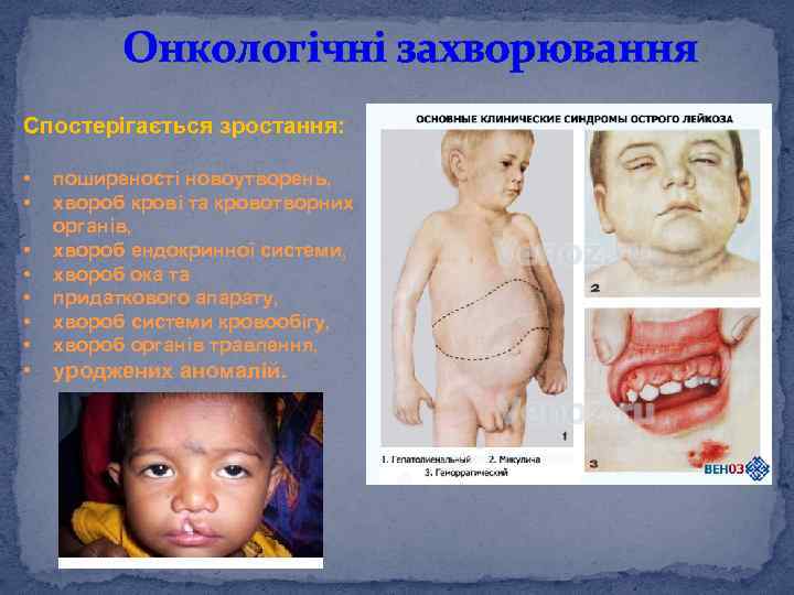 Онкологічні захворювання Спостерігається зростання: • • поширеності новоутворень, хвороб крові та кровотворних органів, хвороб