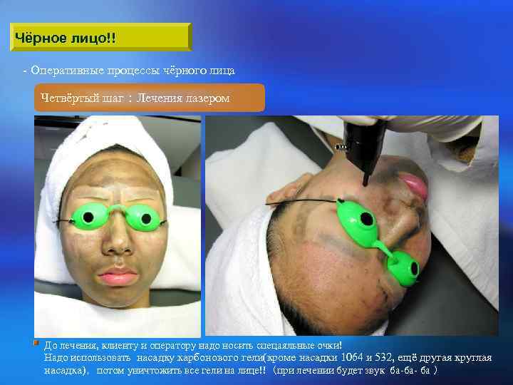Чёрное лицо!! - Оперативные процессы чёрного лица Четвёртый шаг：Лечения лазером До лечения, клиенту и