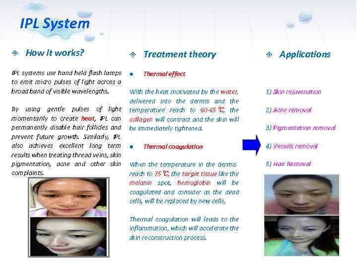 IPL System How it works? IPL systems use hand held flash lamps to emit