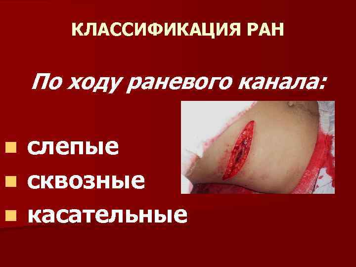 КЛАССИФИКАЦИЯ РАН По ходу раневого канала: слепые n сквозные n касательные n 