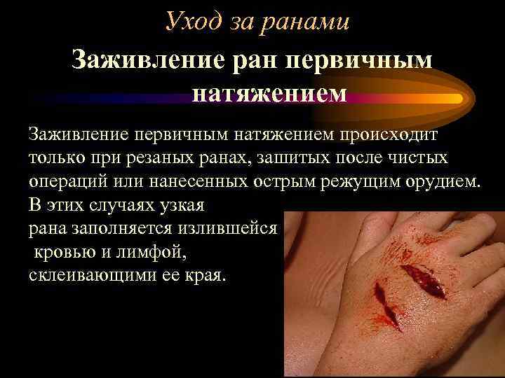 Уход за ранами Заживление ран первичным натяжением Заживление первичным натяжением происходит только при резаных