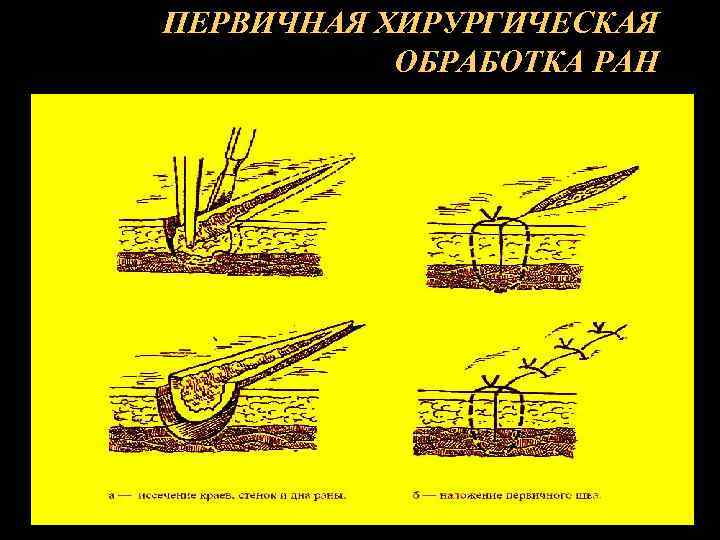 ПЕРВИЧНАЯ ХИРУРГИЧЕСКАЯ ОБРАБОТКА РАН 