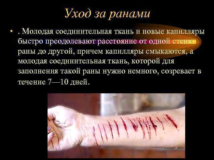 Уход за ранами • . Молодая соединительная ткань и новые капилляры быстро преодолевают расстояние