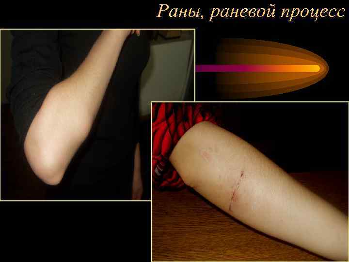 Раны, раневой процесс 