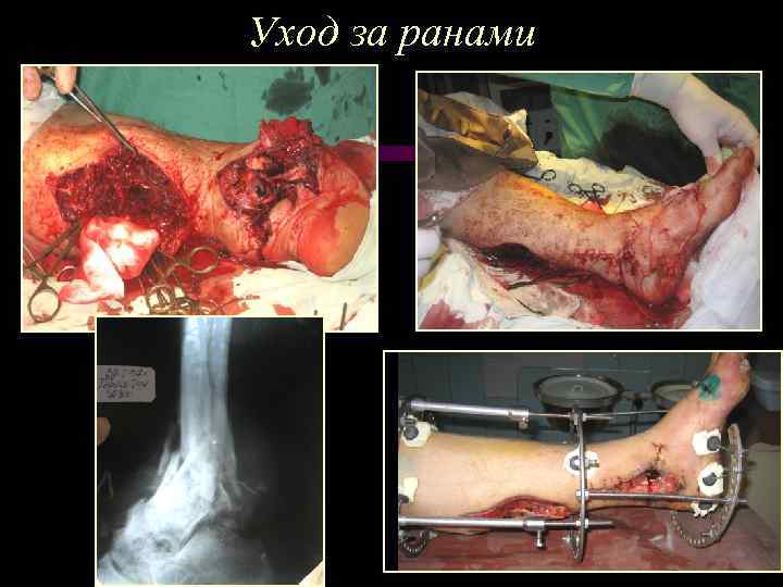 Уход за ранами 