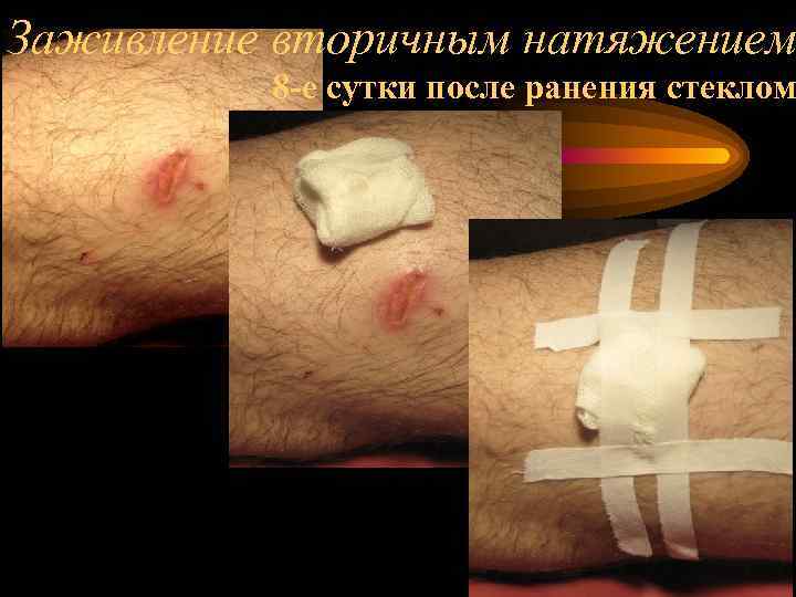 Заживление вторичным натяжением 8 -е сутки после ранения стеклом 