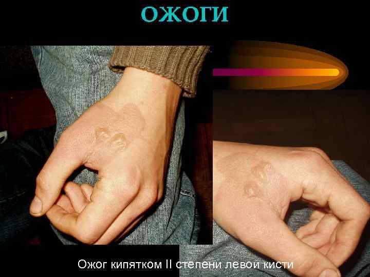 Ожог кипятком II степени левой кисти 