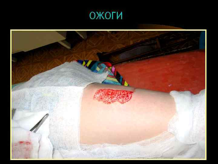 ОЖОГИ 