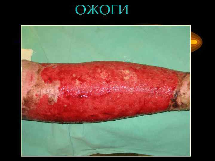 ОЖОГИ 