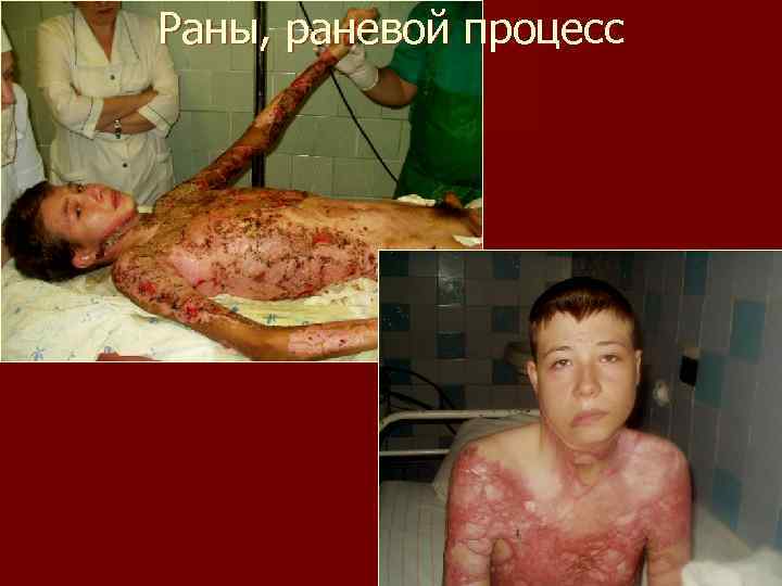 Раны, раневой процесс 