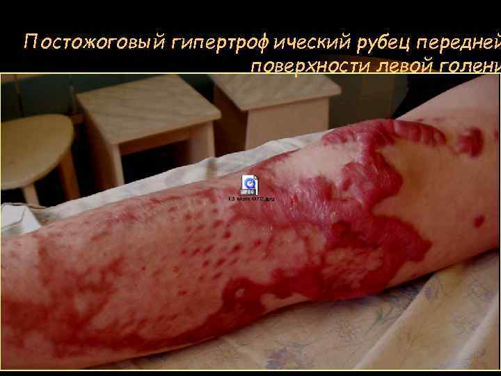 Постожоговый гипертрофический рубец передней поверхности левой голени 