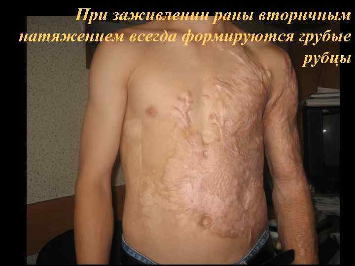 При заживлении раны вторичным натяжением всегда формируются грубые рубцы 