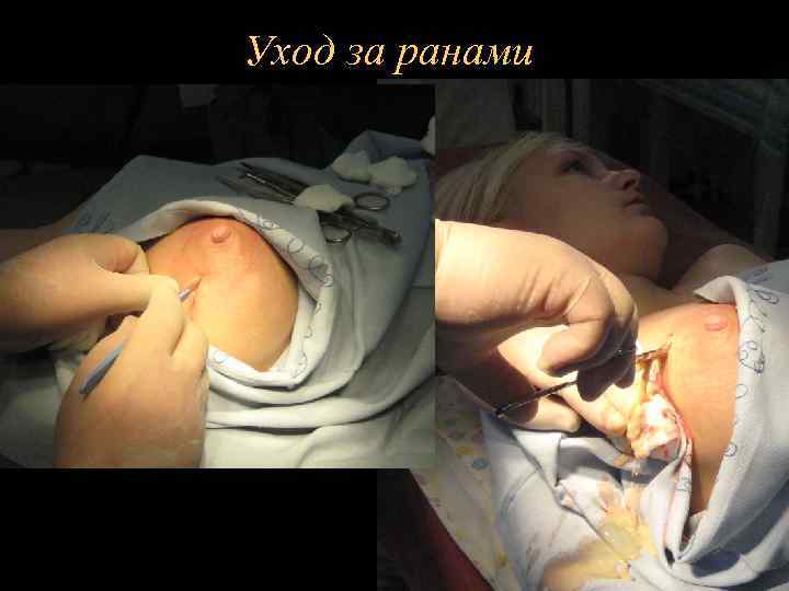 Уход за ранами 