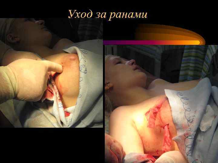 Уход за ранами 