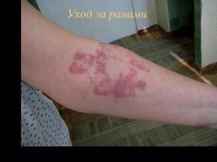 Уход за ранами 