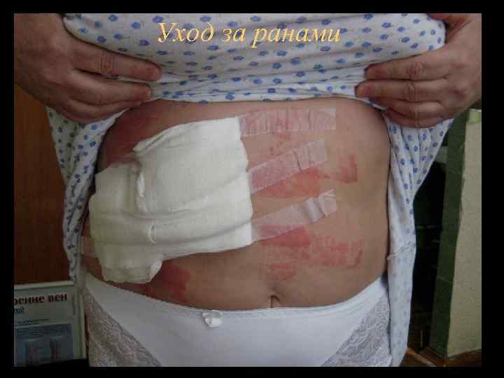 Уход за ранами 