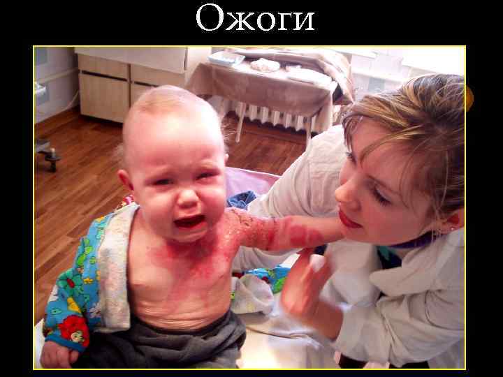 Ожоги 