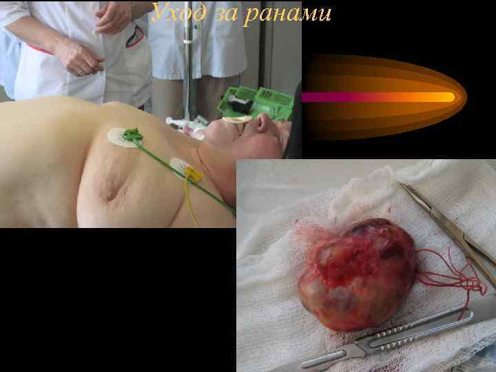 Уход за ранами 