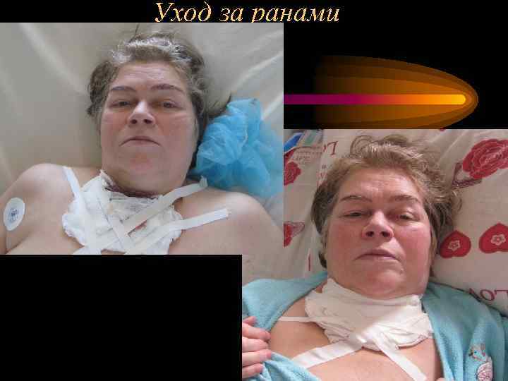 Уход за ранами 