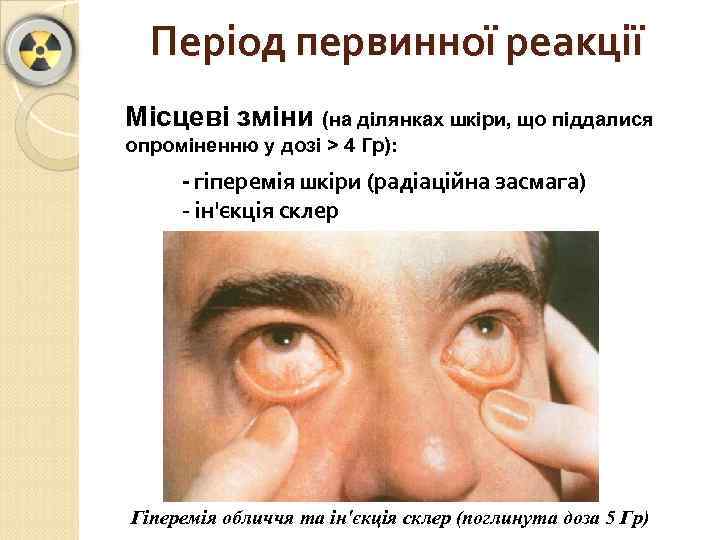 Період первинної реакції Місцеві зміни (на ділянках шкіри, що піддалися опроміненню у дозі >