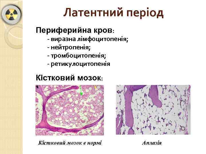 Латентний період Периферийна кров: - виразна лімфоцитопенія; - нейтропенія; - тромбоцитопенія; - ретикулоцитопенія Кістковий
